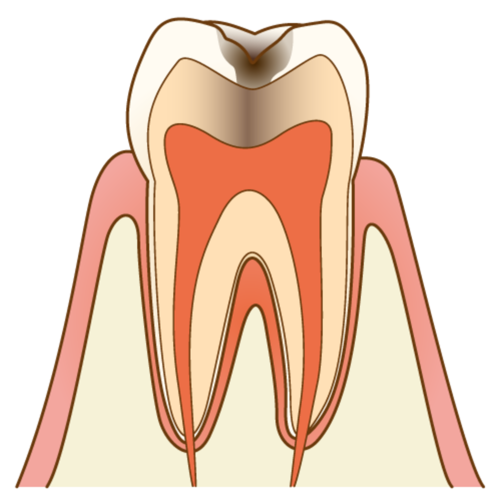 C2（象牙質まで達している虫歯）