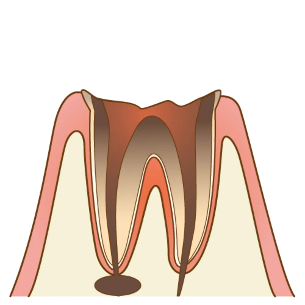 C4(歯根だけ残った虫歯)