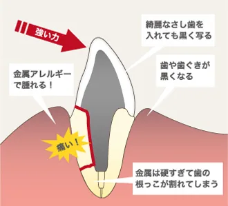 破折歯の治療について