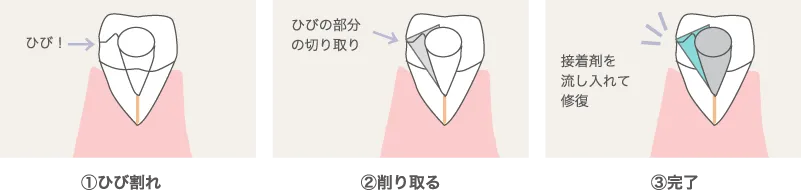 口腔内接着法について