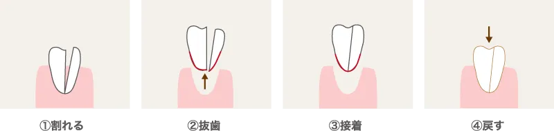 口腔外接着法について(再植)